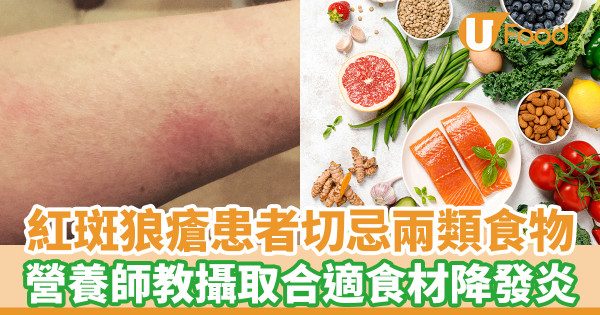 周海媚去世｜紅斑狼瘡患者切忌兩類食物 營養師教攝取合適食材降發炎