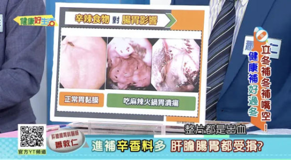 35歲男冬天打邊爐後胃痛吐血 求醫驚揭同時食兩類鍋致胃潰瘍