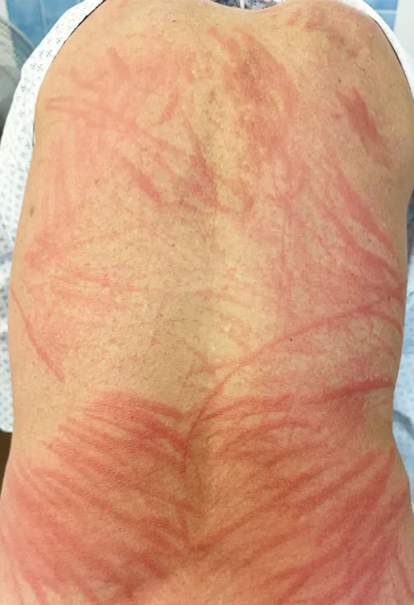 飯後全身出紅疹似被鞭打 注意一事防香菇皮膚炎上身