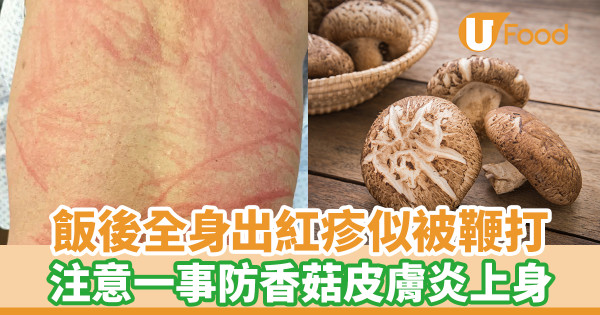飯後全身出紅疹似被鞭打 注意一事防香菇皮膚炎上身