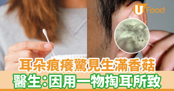 耳朵痕癢驚見生滿香菇 醫生：因用一物掏耳所致