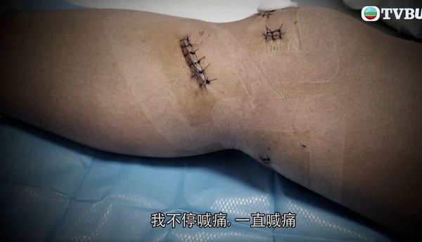 港女深圳水療中心跌倒 致韌帶撕裂花5萬元做手術 店方一理由反駁拒全數賠償