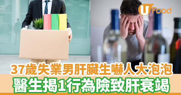 37歲失業男肝臟生大泡泡 醫生揭1行為險致肝衰竭