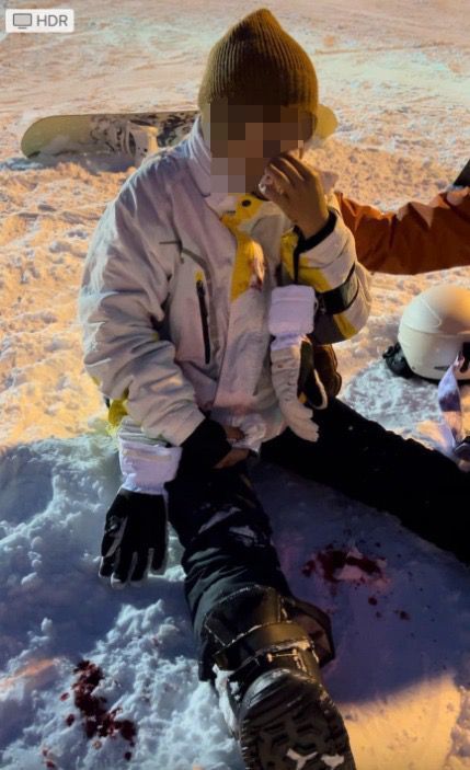 滑雪意外｜台女日本滑雪疑被港女撞傷縫7針險毀容  友人發文狠批肇事者不顧而去冷血 