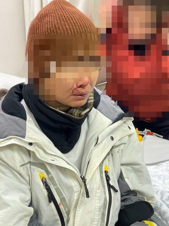 滑雪意外｜台女日本滑雪疑被港女撞傷縫7針險毀容  友人發文狠批肇事者不顧而去冷血 