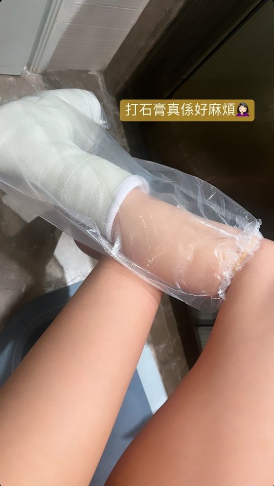 37歲朱智賢行山不慎發生意外右腳骨裂 劇痛8日後求醫打石膏傷勢曝光