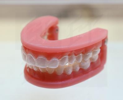 相較於傳統牙箍，隱形牙箍的價格較高，要達到良好的矯正效果，箍牙者需要自律地每天佩戴牙套至少22小時或遵從牙醫建議。