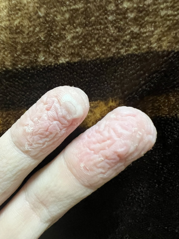 手指皺皮｜浸浴不慎睡著5小時 手指嚴重皺皮劇痛　男子憶述痛苦經歷