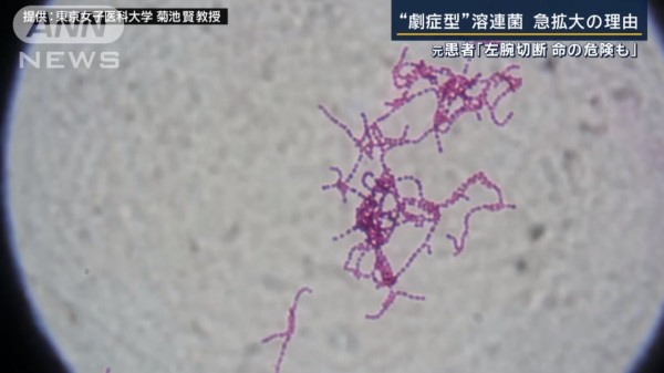 日本「食人菌」爆發感染人數創新高！半年近千個案 死亡率升至5成 