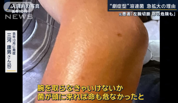 日本「食人菌」個案急增 醫生提醒6類高危人士注意 