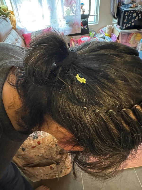 臭屁蟲男子頭髮上播種產卵 14粒綠色蟲卵粘髮絲極驚嚇