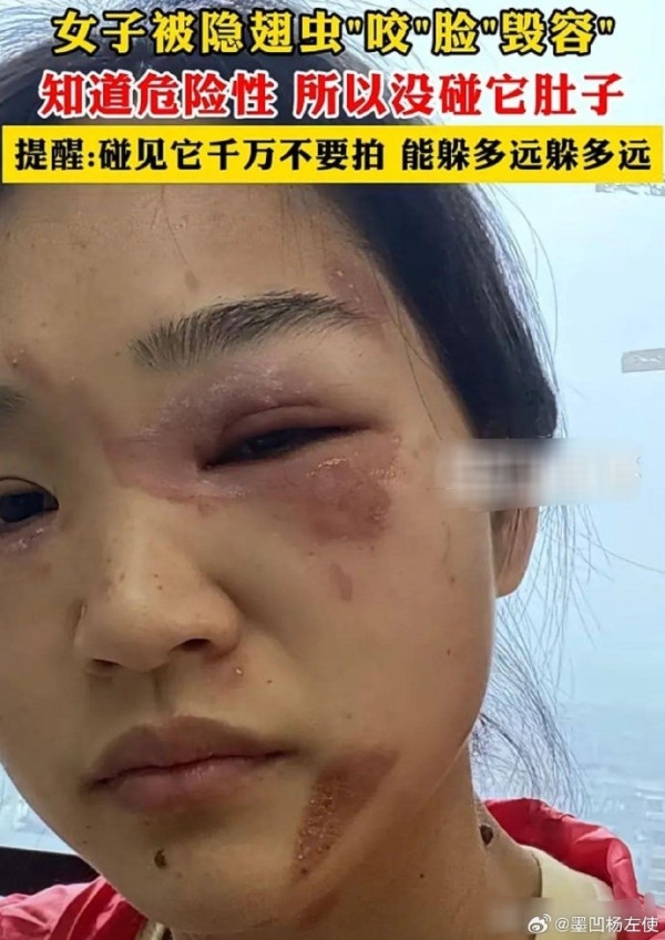 隱翅蟲注意｜黑紅色怪蟲飛近 用手捽死爆毒汁 女子眼部灼傷恐留巨疤