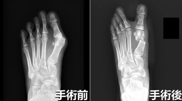 拇趾外翻｜高跟鞋穿一整日 女模特兒嚴重拇趾外翻 須做手術拉回正常角度