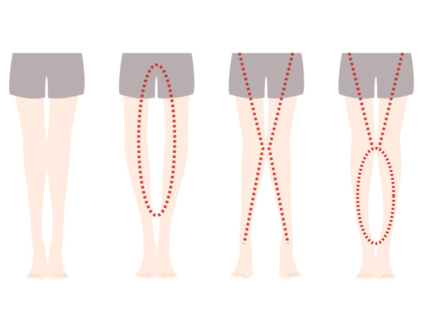 如何判斷自測XO腿型？