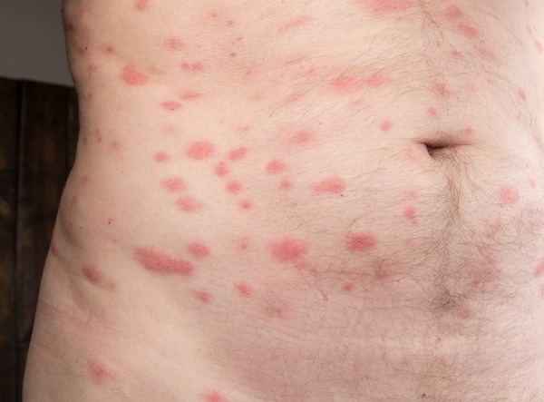 蝨咬咬痕會較密集，多呈一串串紅疹，每顆紅腫位面積較細，但嚴重可以遍佈全身。