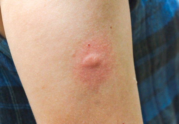 蚊蟲叮咬一般呈現1至2個比較大的紅腫，多數在外露手腳為主。