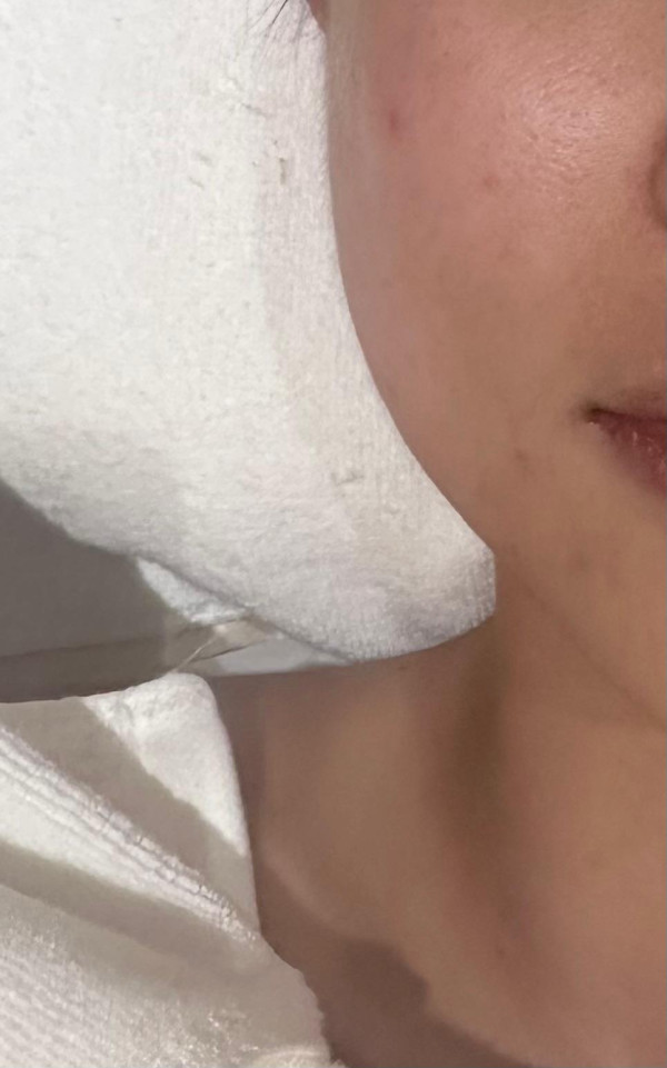 日式小顏對比圖｜前