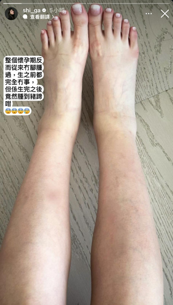 連詩雅產後驚現腳腫如豬啼