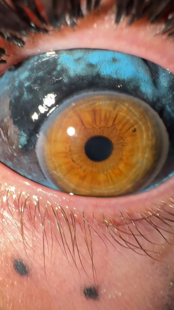 澳洲「青眼白龍」紋身女王Amber Luke 紋眼球致三週失明 稱困擾但值得