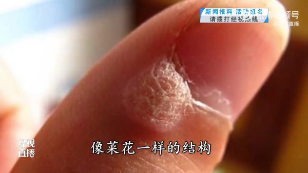 最近她發現指甲縫裡長出透明小包。（影片截圖）