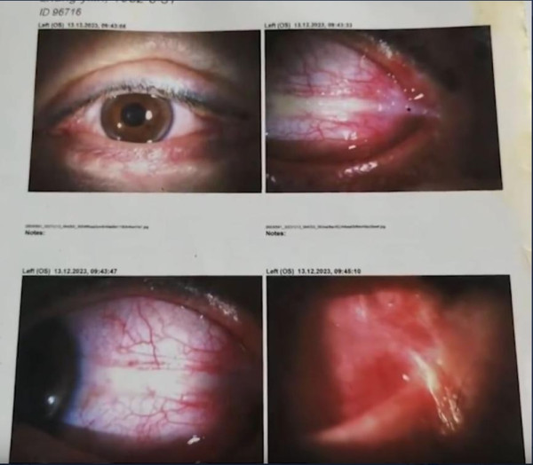恐怖慎入｜女子內地花3萬元割雙眼皮 眼球眼皮慘被縫起無法轉動 