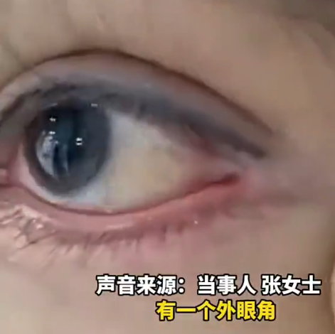 恐怖慎入｜女子內地花3萬元割雙眼皮 眼球眼皮慘被縫起無法轉動 