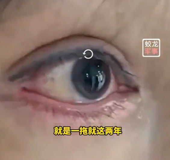 恐怖慎入｜女子內地花3萬元割雙眼皮 眼球眼皮慘被縫起無法轉動 