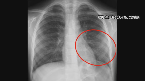 遊日注意！日本東京梅毒病例創新高！4階段症狀！附專家3大預防建議 
