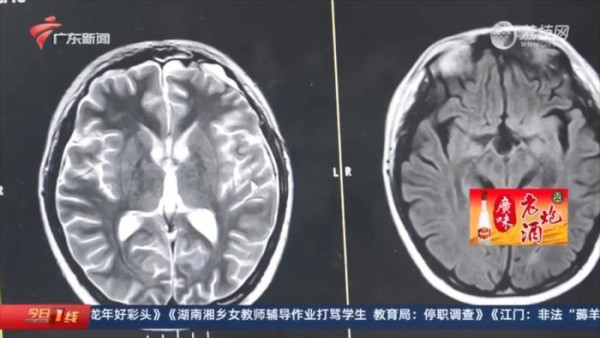 彬彬被診斷為混合型生殖細胞腫瘤。（影片截圖）