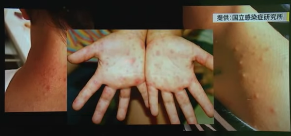 遊日注意|日本手足口病患者急增至2.5萬! 政府呼籲做2件事避免感染
