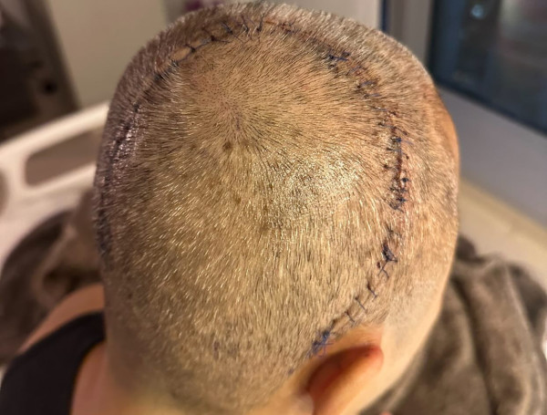 草蜢57歲蔡一傑缺席美國巡唱 驚揭罹腦瘤 PO頭頂巨型傷口報平安 