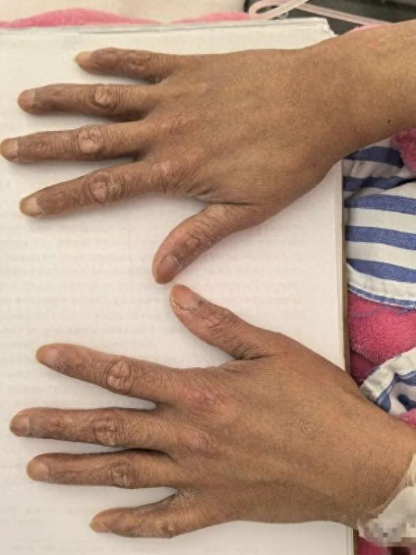 27歲女三亞旅遊遭毒蛇咬翌日亡 家屬質疑醫院延誤治療錯失黃金時間 附應急教學 