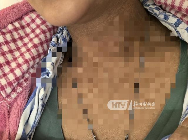 27歲女三亞旅遊遭毒蛇咬翌日亡 家屬質疑醫院延誤治療錯失黃金時間 附應急教學 