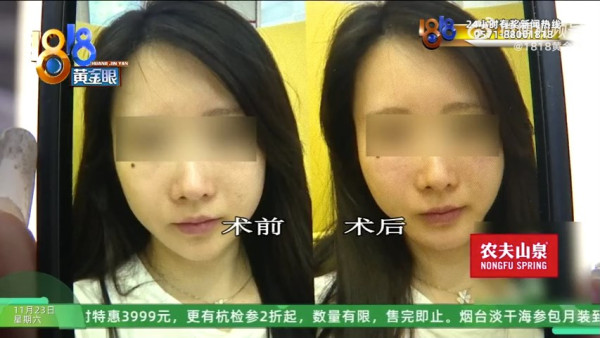 杭州女整容後被嫌老了十年 向媒體投訴上門求賠償 網民：主管整成這樣你也敢消費 