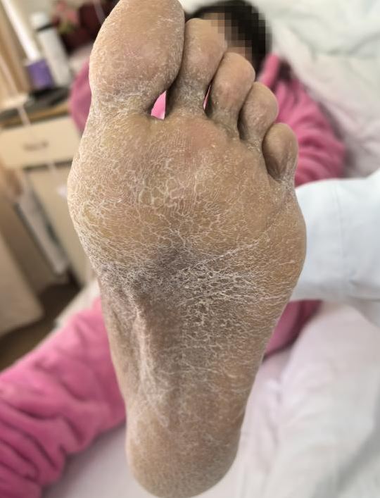 27歲女三亞旅遊遭毒蛇咬翌日亡 家屬質疑醫院延誤治療錯失黃金時間 附應急教學 