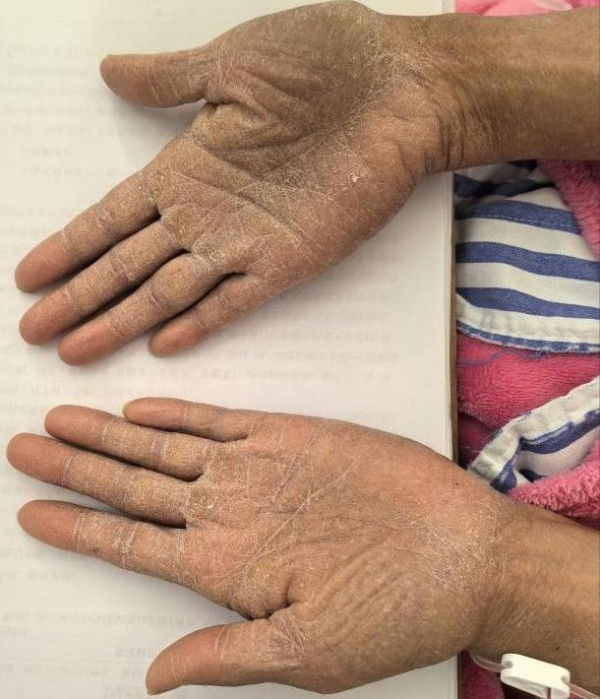 27歲女三亞旅遊遭毒蛇咬翌日亡 家屬質疑醫院延誤治療錯失黃金時間 附應急教學 