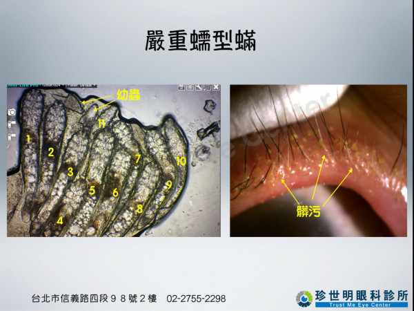 女子眼乾痕癢驚揭睫毛藏11條蟎蟲！全因洗面時做漏1步驟 