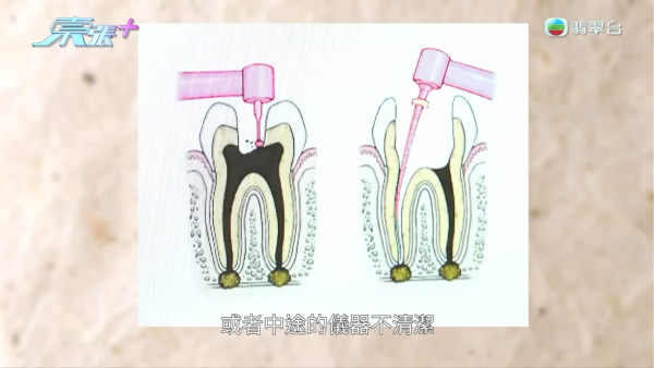 陳醫生指出，王小姐牙齒很大機會是深圳杜牙根時，有不潔儀器將細菌帶入牙根，導致牙根、牙齦位置發炎。