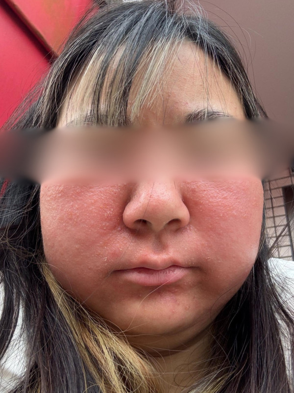 港女日本浸溫泉敏感要睇急症 臉部腫脹流膿 附醫生教如何正確浸溫泉