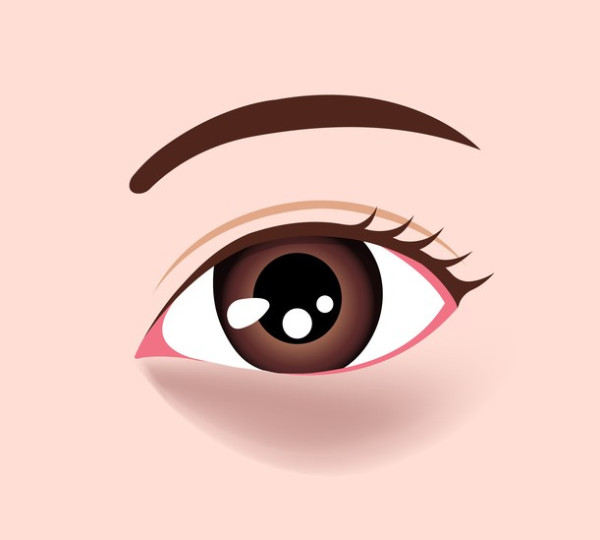 2. 色素型黑眼圈|黑眼圈顏色呈棕色或灰色,無論拉扯皮膚或改變光線,顏色均無明顯變化。