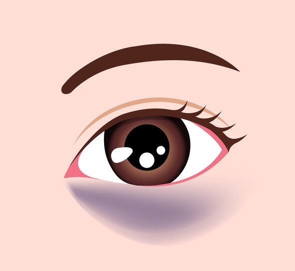 1. 血管型黑眼圈|黑眼圈顏色呈青紫色,早晨起床時較明顯,按壓時顏色可能變淡