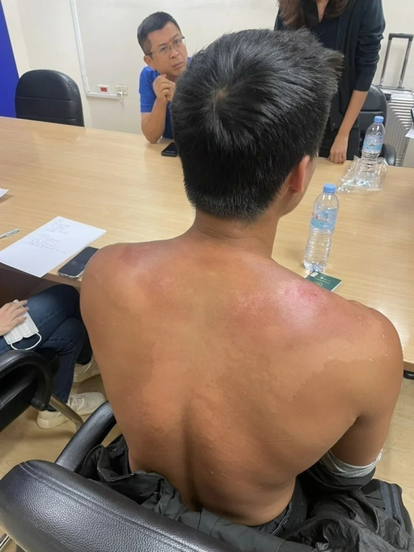 KK園區｜火舞表演者被賣豬仔後獲救 憶述園內恐怖經歷！曾被毆打兼暴曬 