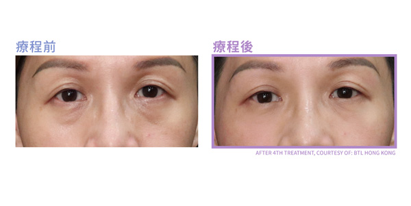 眼袋槍原理效果