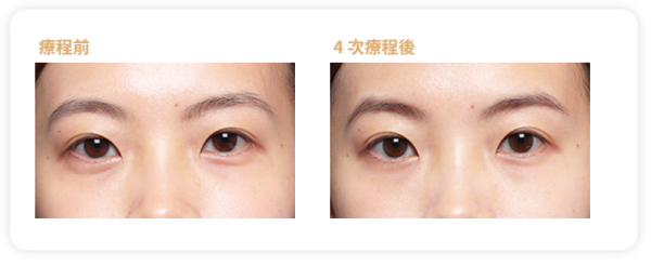 眼袋槍原理效果