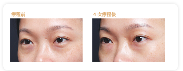 眼袋槍原理效果