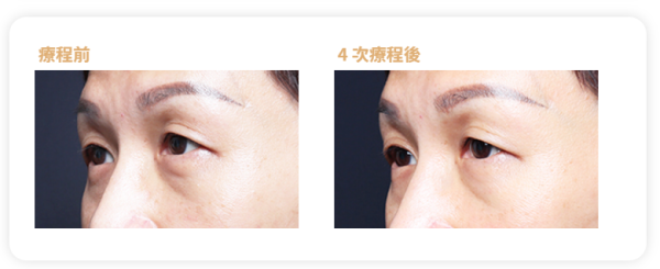 眼袋槍原理效果