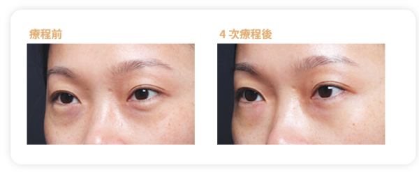 眼袋槍原理效果