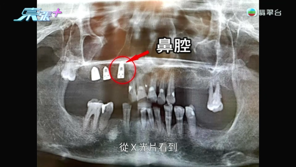 經吳醫生檢查後，發現李女士所植入牙槽骨的螺絲，較標準長了2毫米，導致刺入鼻腔引起發炎。