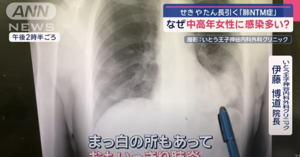 遊日注意｜不止流感！日本NTM肺病肆虐 中高齡女性及從事這行業成高危群組 