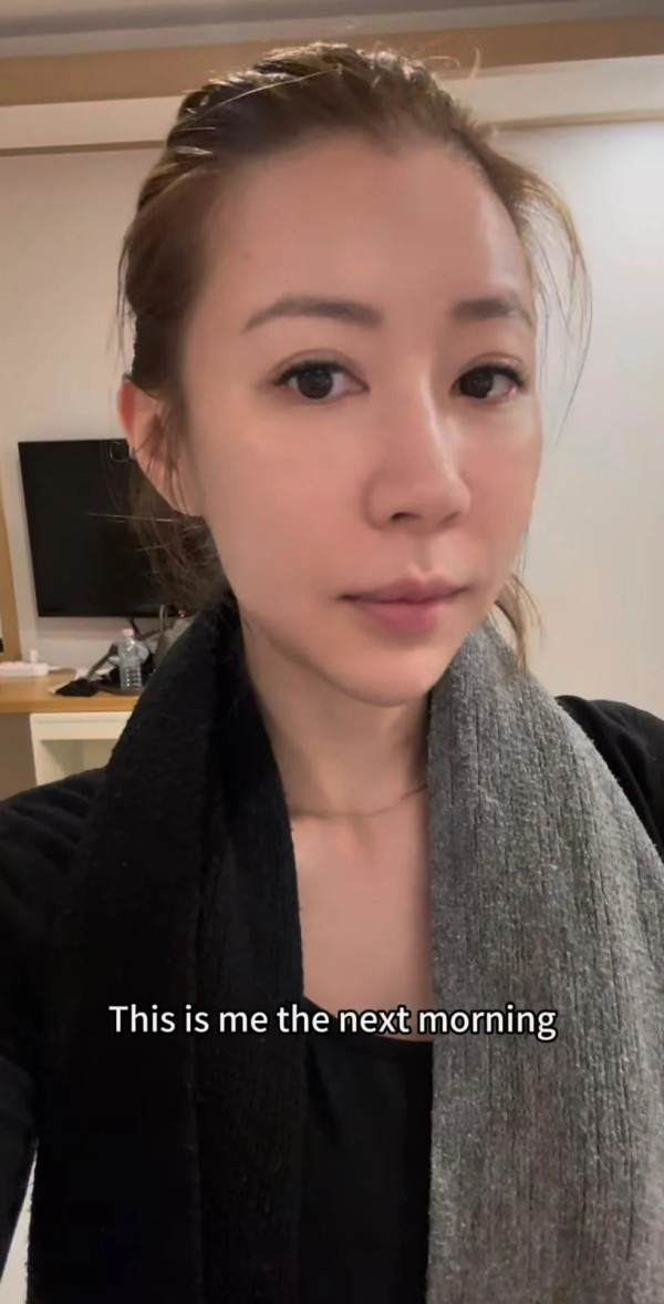 TVB咪神飛韓國做醫美打針 大方公開術後皮膚狀態嚇人